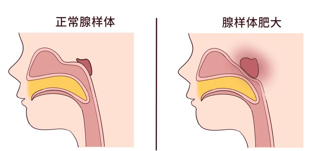 發(fā)現腺樣體肥大就要“嘎一刀”？大可不必！